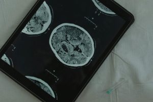 Alzheimer's disease, dementia, memory loss